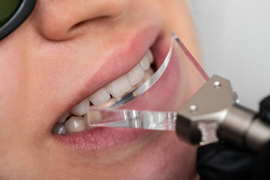 Gum correction surgery with laser
