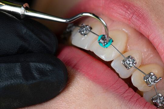 Dental braces examination, ororthodontic consultation