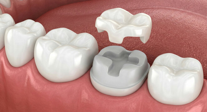 Dental Crown Restoration Process Illustrated with 3D Tooth and Gum Model