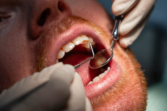 Dentist in protective gloves examining a patient's open mouth with dental tools