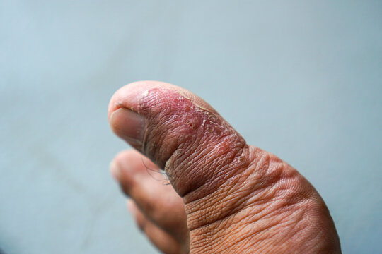 closeup toe with painful blister and peeling skin showing irritated inflamed foot condition