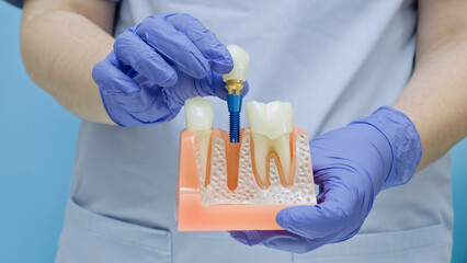 Dentist's hands in blue gloves demonstrating the placement of a dental implant with crown into a jaw bone model.