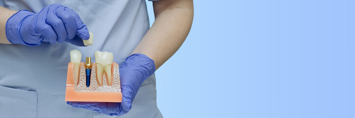 Dental implant banner with copy space: Dentist hands holding jaw model with titanium screw and ceramic crown.