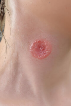 A photorealistic image of a real human neck affected by ringworm tinea corporis