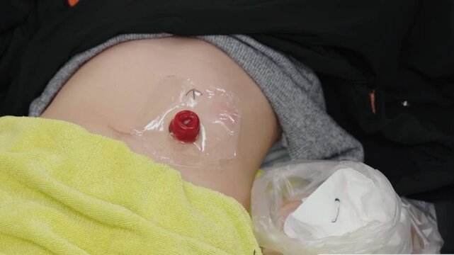 Close-up of hands cleaning a stoma site with professional medical wipes.