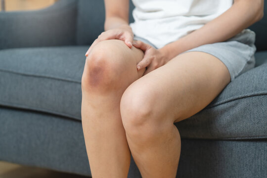 Close up of stain bruise wound on arm, contusion asian young woman, girl an accident fell down stairs, hand on knee in healing injury by massage hematoma blood
