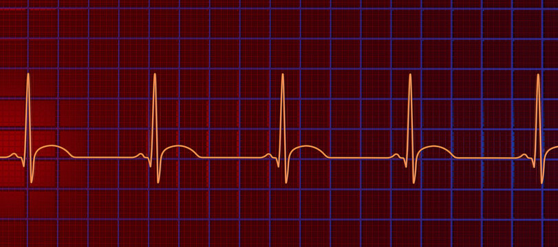ST-elevation on ECG, 3D illustration