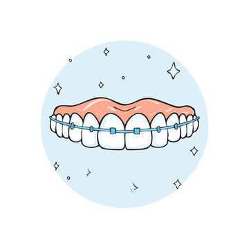 Illustration of straight white teeth with blue orthodontic braces and sparkling highlights