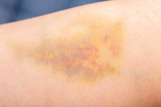 Bruises on the human body. Severe bruise from impact, bruising and hematoma.