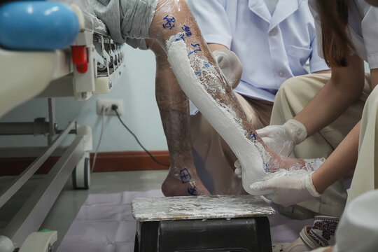 Prosthetist making a plaster cast of a patient's leg for a custom Ankle Foot Orthosis (AFO). Professional orthotic fitting process in a rehabilitation clinic.