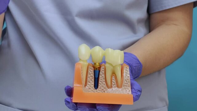 dental professional in protective gloves holding an anatomical jaw model and demonstrating a dental bridge placement over an implant abutment.