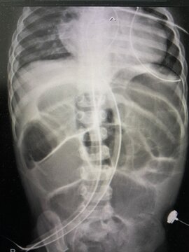 Film x-ray show diffusely dilated bowel loops, bowel ileus for medical and technology concept