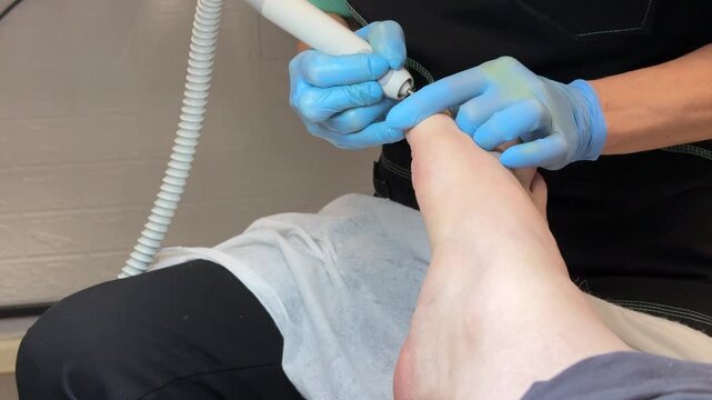 Onychomycosis. Process of hardware treatment of toenails by a doctor with various diamond feathers. Dangerous fungal infection of toenails in person sitting in an examination chair. Regular cleaning.