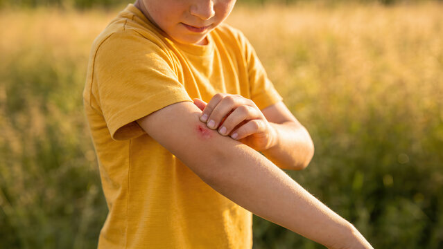 Young boy in yellow t-shirt examines insect bite on his arm while standing in a grassy field during a sunny day, with blurred background of tall grass and nature