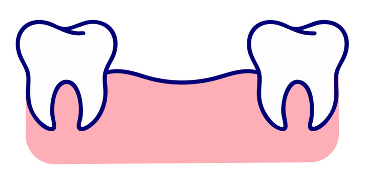 Missing Tooth Gap After Extraction, Empty Space in Gum After Tooth Removal, Dental Loss and Implant Need