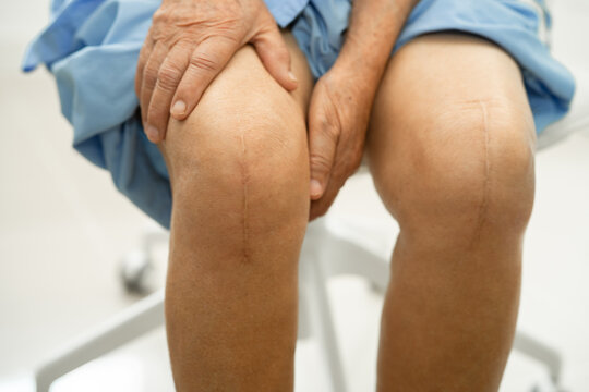 Asian elderly woman patient show her scars surgical total knee joint replacement Suture wound surgery arthroplasty on bed in hospital.
