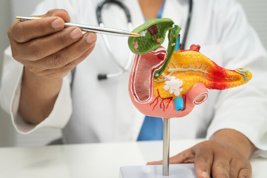 Pancreatitis, pancreatic cancer, Asian doctor with pancreas, gallbladder and bile duct human anatomy model at hospital.