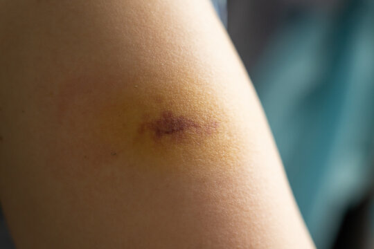 Bruise injury found on the female arm
