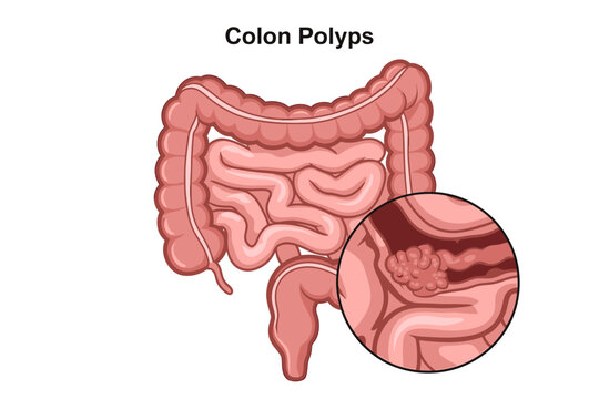 Illustration of human colon showing internal polyps with a magnified view of growths
