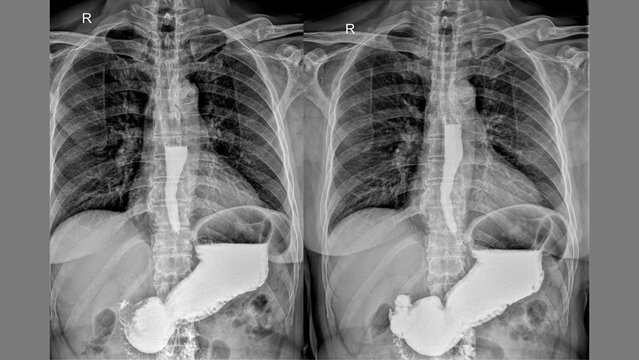 Upper Torso X‑ray with Barium Contrast, AP Views