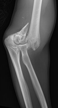 Medical X-ray of Elbow Joint Showing Distal Humerus Fracture and Supracondylar Trauma.
