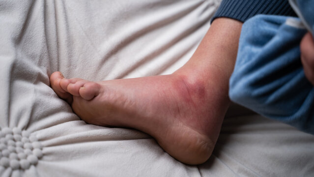 Top view of injured foot with a cold compress on the bed. Ankle injury, swelling, inflammation, and home treatment.