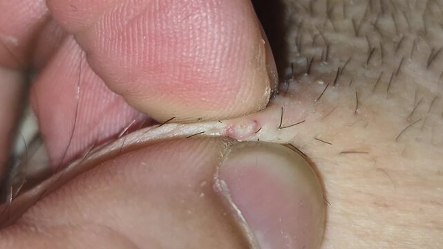 Remove pimple on the skin with hair.
