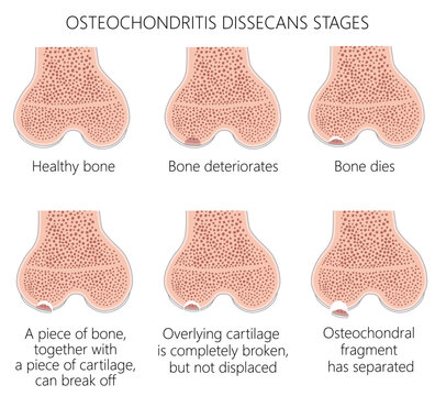 Osteochondritis dissecans stages