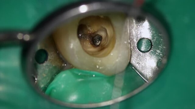 Dental cleaning overview. Detailed examination of dental irrigation and canal cleaning techniques. Understanding intricate processes involved in dental irrigation and canal sanitation methods