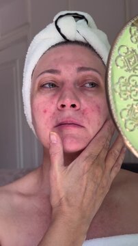 Upset middle aged woman with sensitive irritated skin applies hand to face looking in mirror, visible redness and uneven texture, frustration with appearance and daily skincare struggle