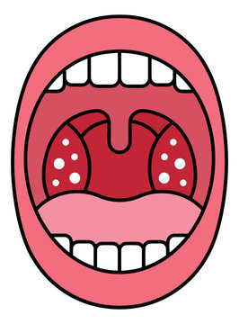 Cartoon illustration of an open mouth depicting inflamed tonsils with white spots for medical and healthcare design