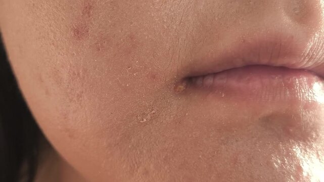 A purulent pimple near the lip on the chin of a young woman. Acne in adolescents.