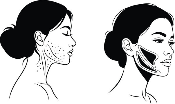 Facial muscle anatomy illustration side views showing superficial musculature