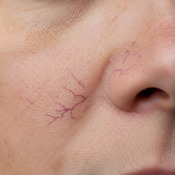 Close-up of skin showing visible veins on a person's cheek  