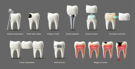 Fototapeta na wymiar Dental tools and procedures including crowns implants caries restoration and examination