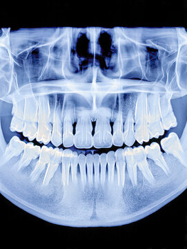 Dental panoramic radiograph showing full set of teeth and jaw structures with clear visibility of roots and sinus cavities for oral health evaluation
