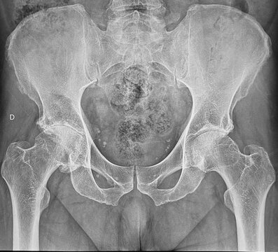 Hip X-ray showing advanced osteoarthritis in the right hip.  Bras&iacute;lia, Brazil, 2026.