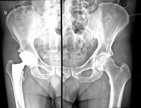 X-ray taken after right hip arthroplasty surgery, involving the implantation of a titanium-ceramic prosthesis to correct advanced osteoarthritis. Bras&iacute;lia, 2026