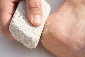 Fototapeta premium Hand firmly rubbing a porous grey pumice stone against the dry cracked skin of a human heel for exfoliation