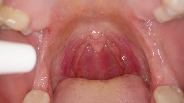 Spray Being Applied into Sore Throat with Redness and Visible Veins on Soft Palate and Uvula, Extreme Macro Close-Up, Medical Treatment Concept