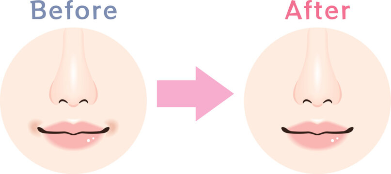 口周りのくすみ Before After