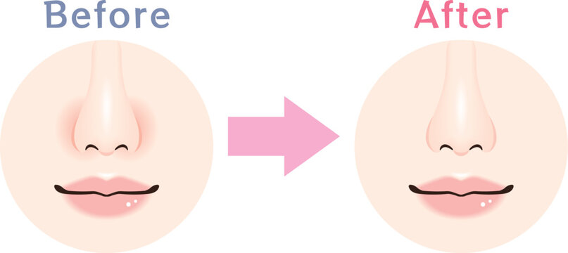 小鼻の赤み ビフォーアフター 比較イラスト