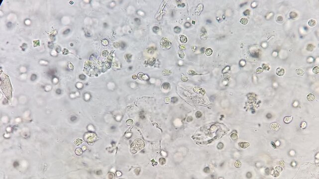 Footage of Calcium oxalate monohydrate, pus cells in urine under microscope.