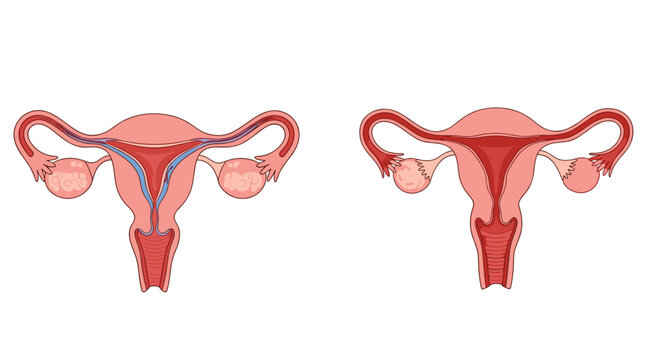 Medical illustration showing a comparison of a healthy human uterus and ovaries with one showing abnormal changes or conditions on white.