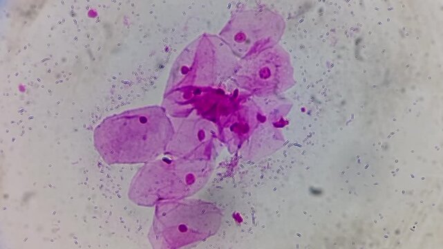 Female HVS Gram Stain. Gram positive bacilli seen. Suggestive of lactobacilli.