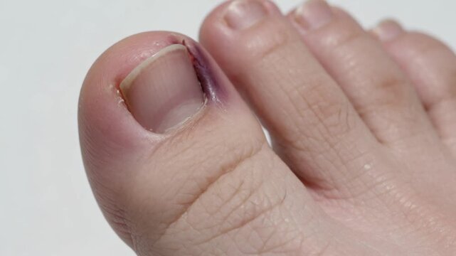 Close-up of a Bruised Toenail on a Human Foot
