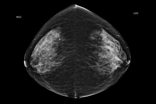 Bilateral craniocaudal (CC) view  mammogram of healthy breasts showing benign tissue (BI-RADS 2).