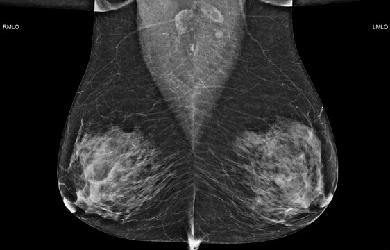 Bilateral mediolateral oblique (MLO) mammogram of healthy breasts showing benign tissue (BI-RADS 2) .