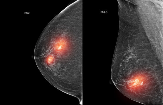 Bilateral mammogram x-ray displaying benign calcifications in both breasts with red highlight. Medical concept for women's health screening, routine checkup, and non-cancerous breast conditions.