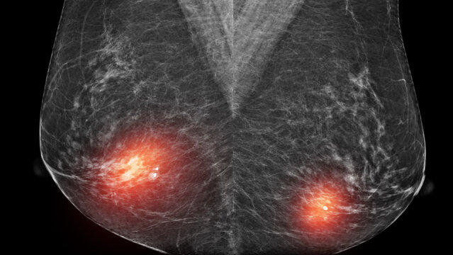 Bilateral mammogram x-ray displaying benign calcifications in both breasts with red highlight. Medical concept for women's health screening, routine checkup, and non-cancerous breast conditions.